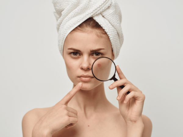 woman zooming on a pimple with a magnifying glass