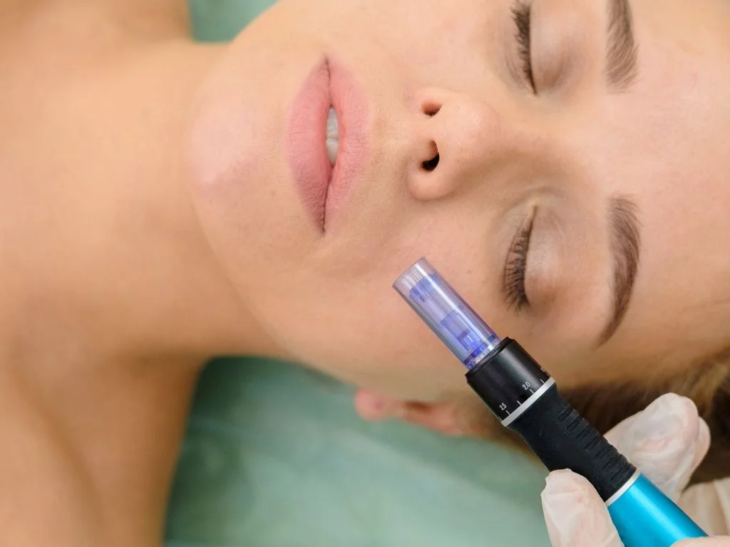 woman with closed eyes receiving a microneedling treatment