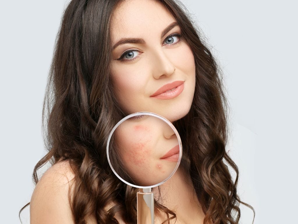 woman with cliean face and before and after zoom for acne