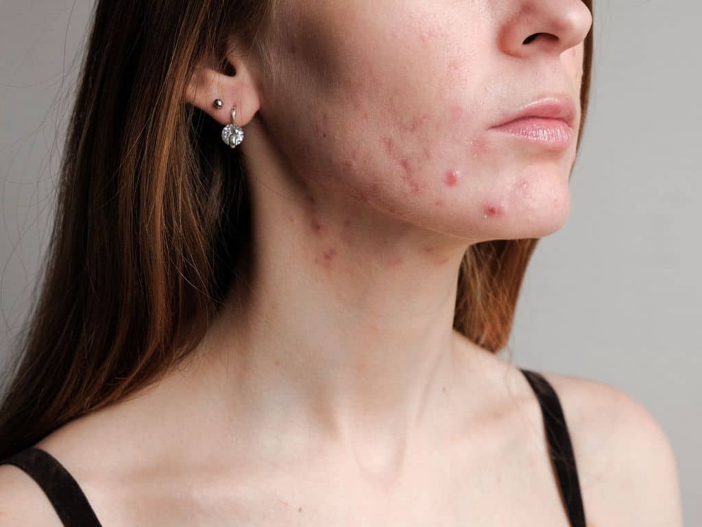 woman with acne and scars on her jawline and cheeks