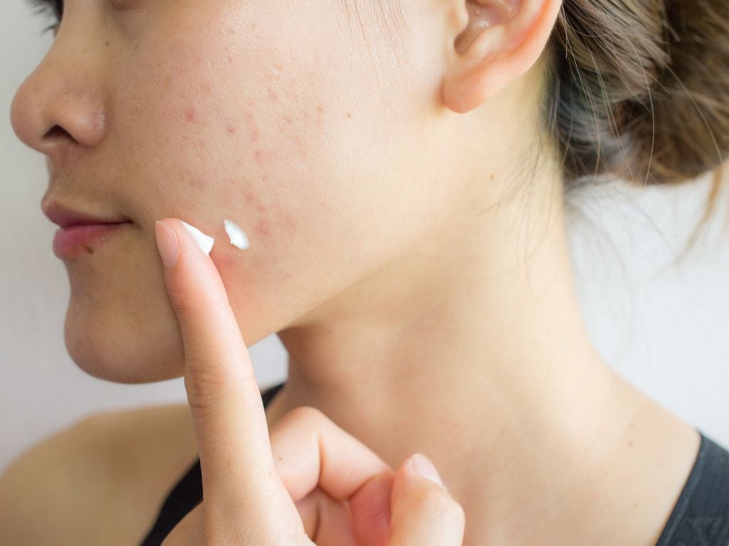 woman applying with a finger a topical cream on acne