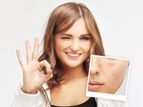 woman with clear skin and example of how her face looked before acne treatment