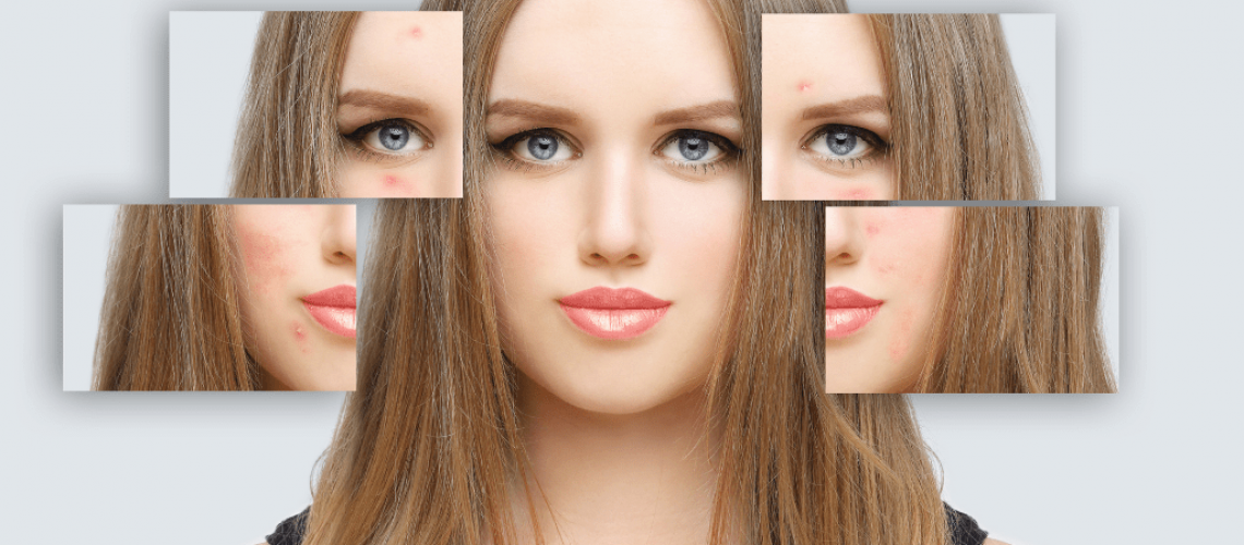 acne split face images