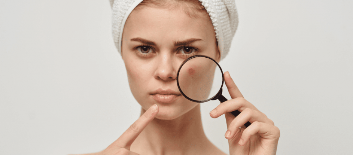 woman zooming on a pimple with a magnifying glass
